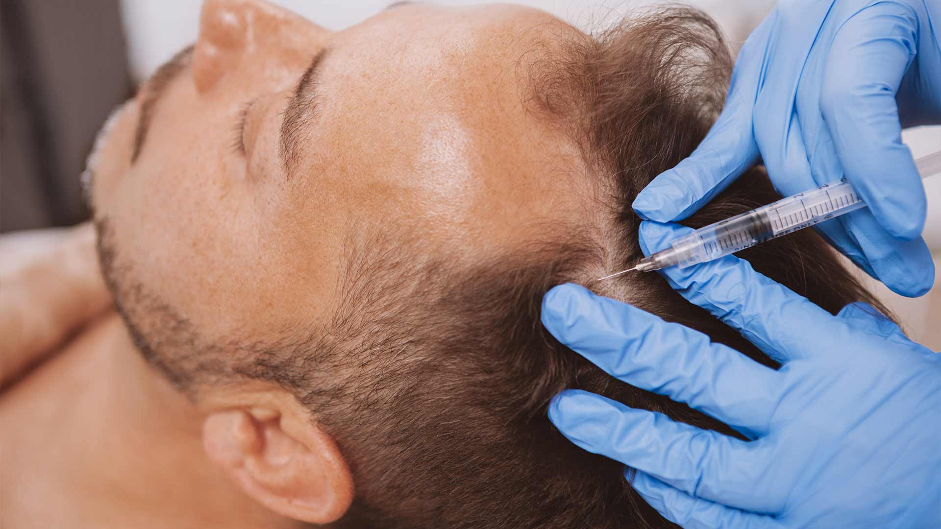 How Long Should You Stay In Turkey After Hair Transplant?