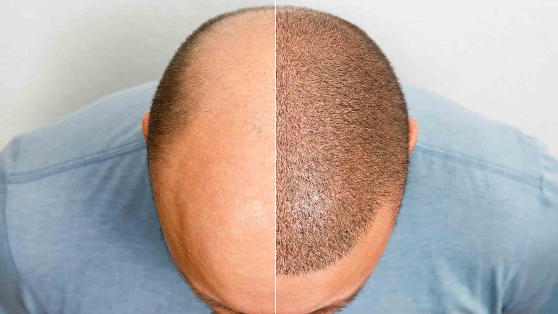 Is Istanbul Good for Hair Transplant?