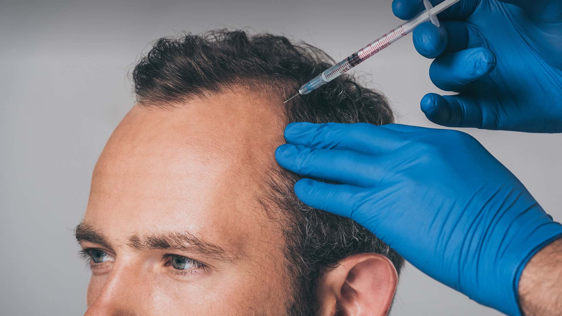 Revealing the Truth: Is it Safe to Go to Turkey for Hair Transplant?